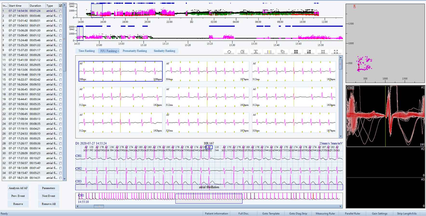 Atrial Fibrillation Edit